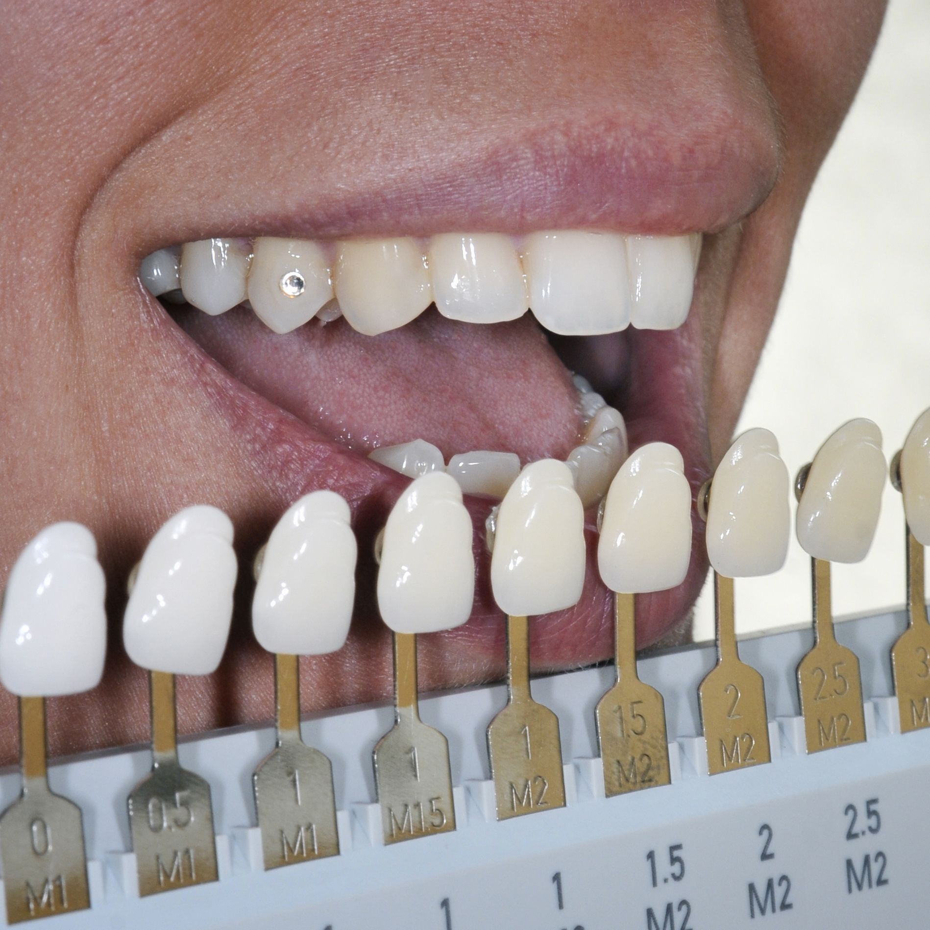 Fountain Valley CA Professional Teeth Whitening Vs Over the Counter Fountain Valley CA Professional Teeth Whitening Vs Over the Counter