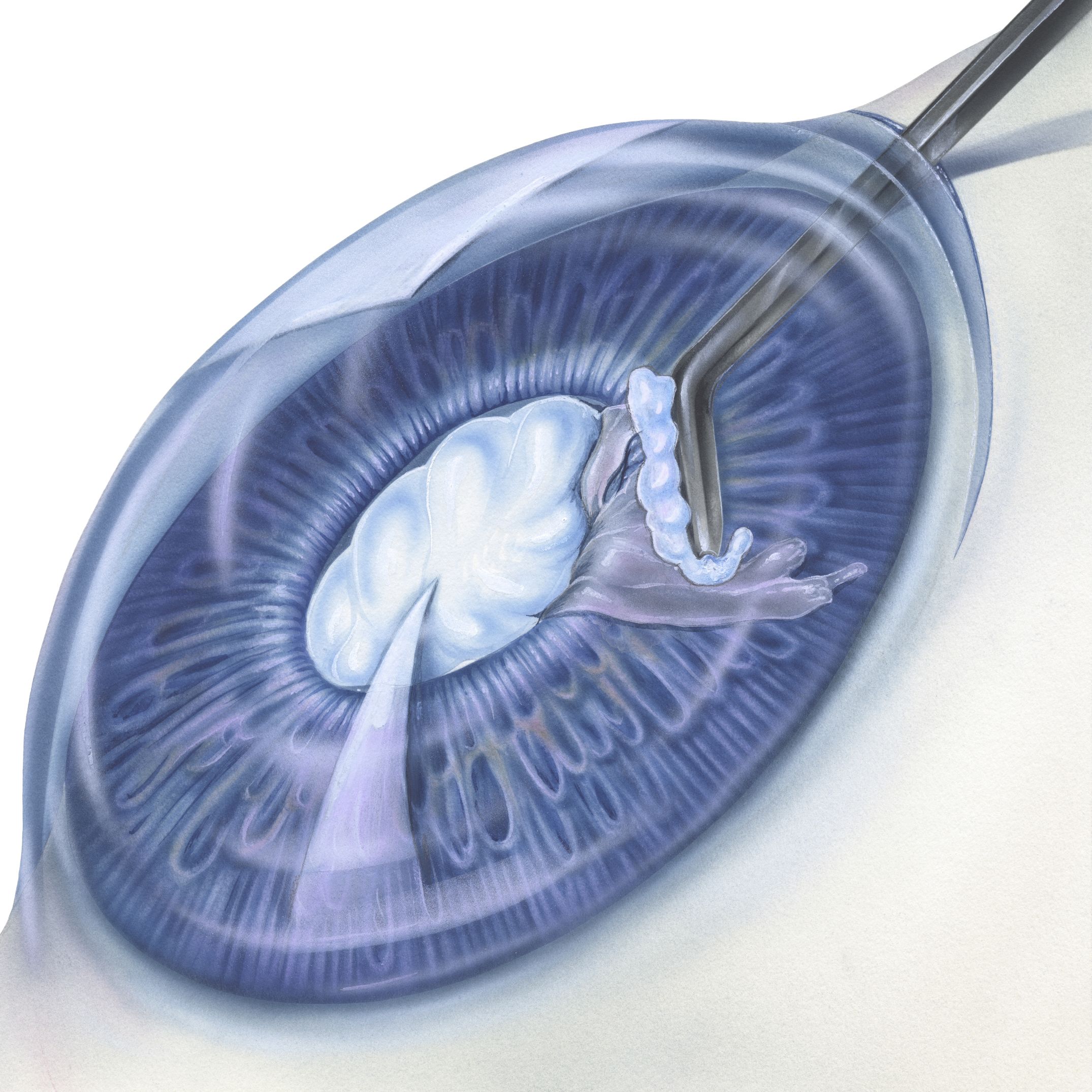 cataract treatment