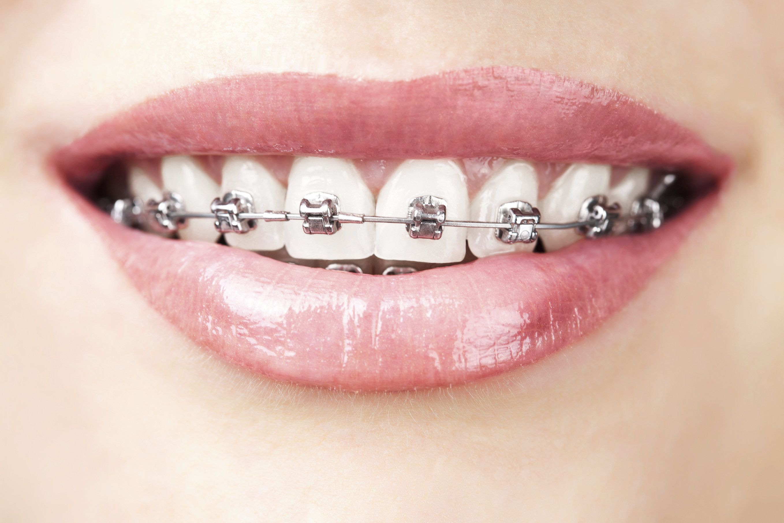 How To Manage Rubber Bands and Braces Pain