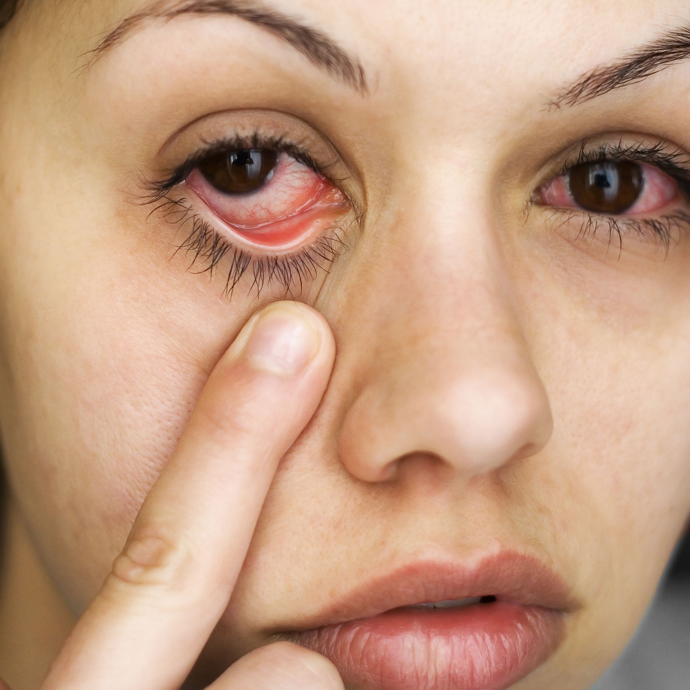 A woman with eye allergies