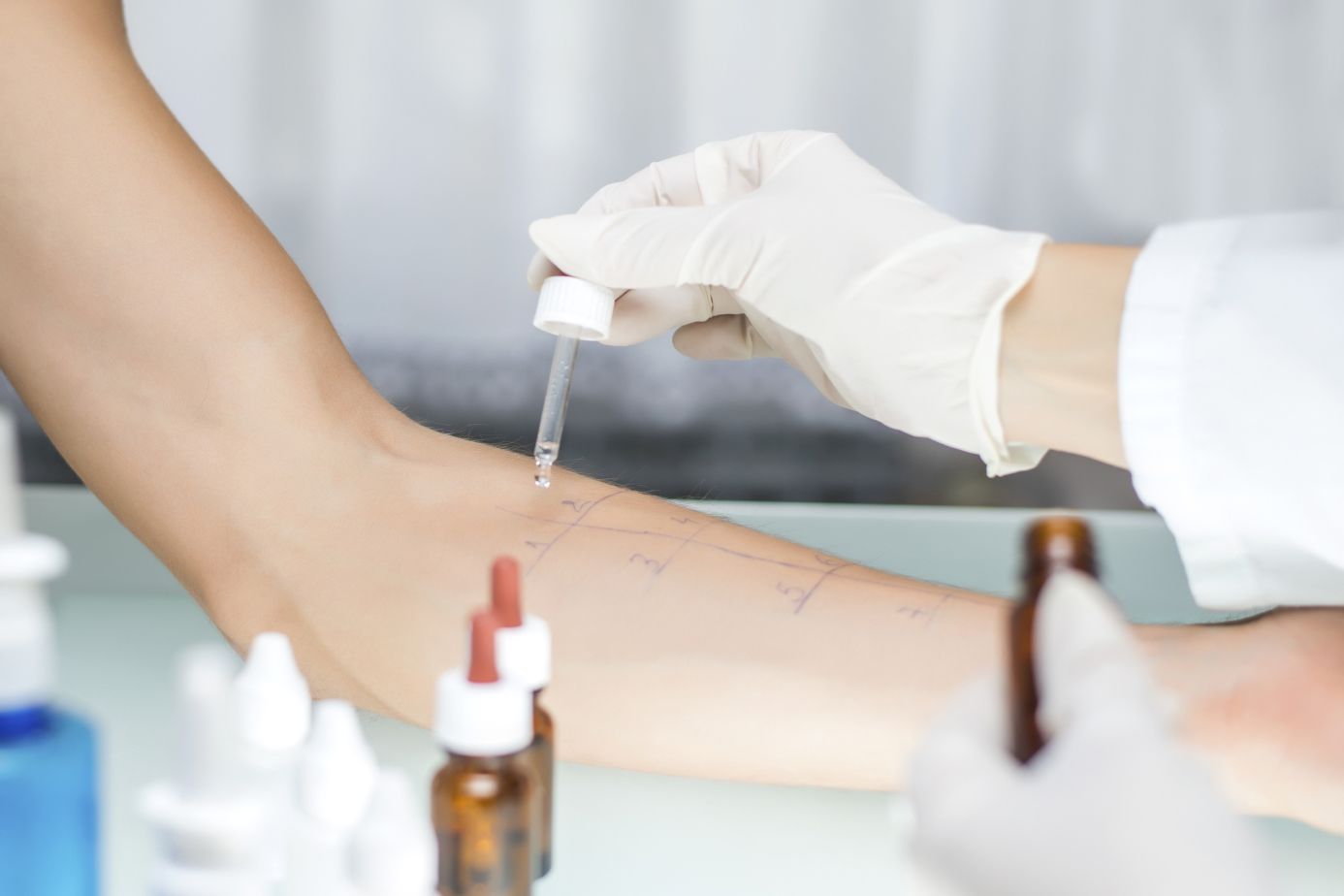 Patient undergoing allergy testing on his/her arm