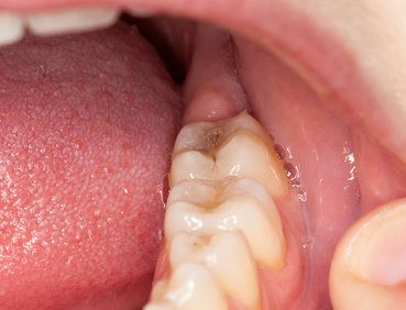 Close up of molars