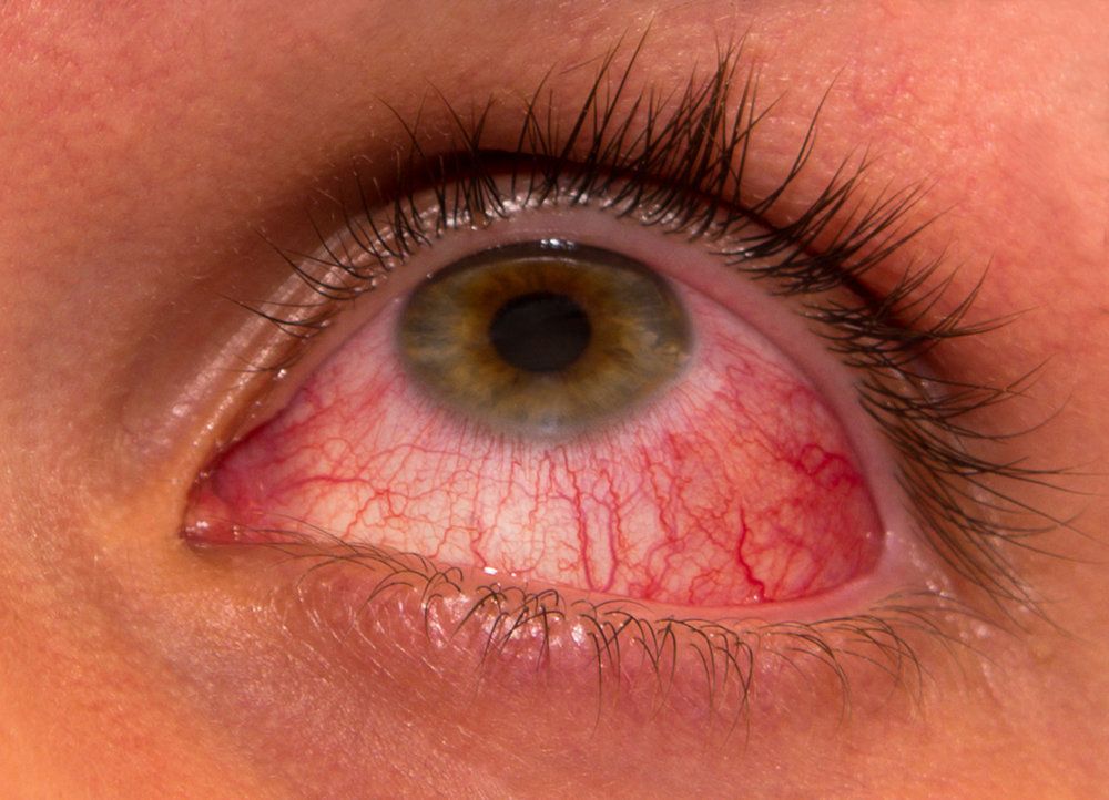 Close shot of eye infected with pink eye