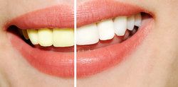 Memphis Teeth Whitening Candidates