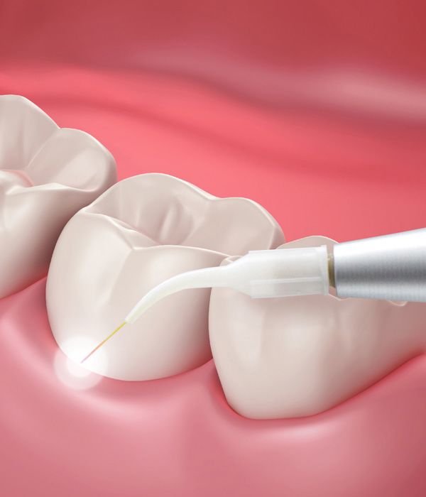 Illustration of laser periodontal treatment