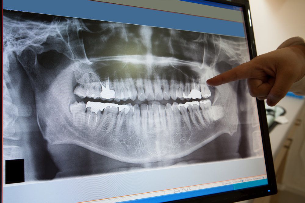 Technician pointing at patient's dental x-ray on monitor