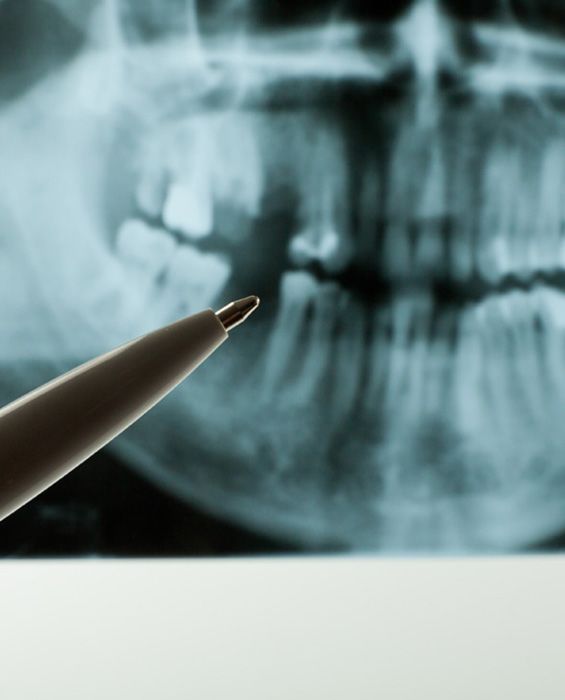 Illustration of a tooth extraction
