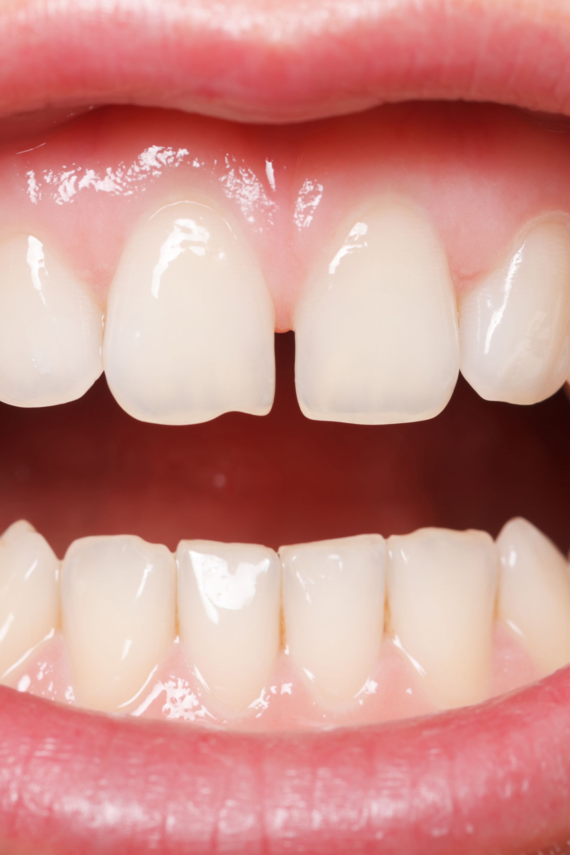 dental gaps