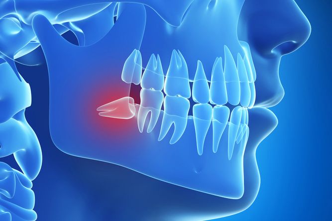 digital illustration of a mesially impacted wisdom tooth