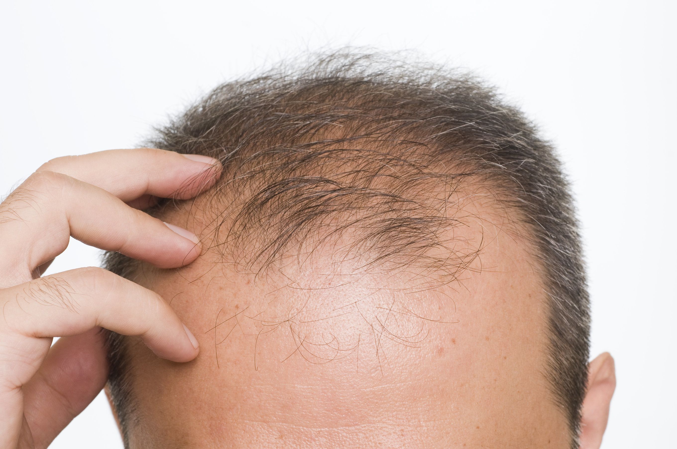 up close photo of man’s receding hairline