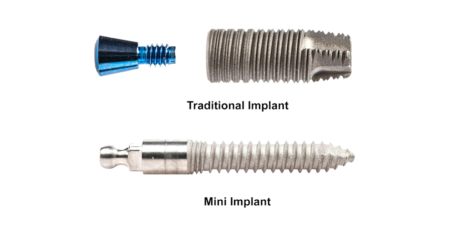 Traditional vs. Same Day Implants