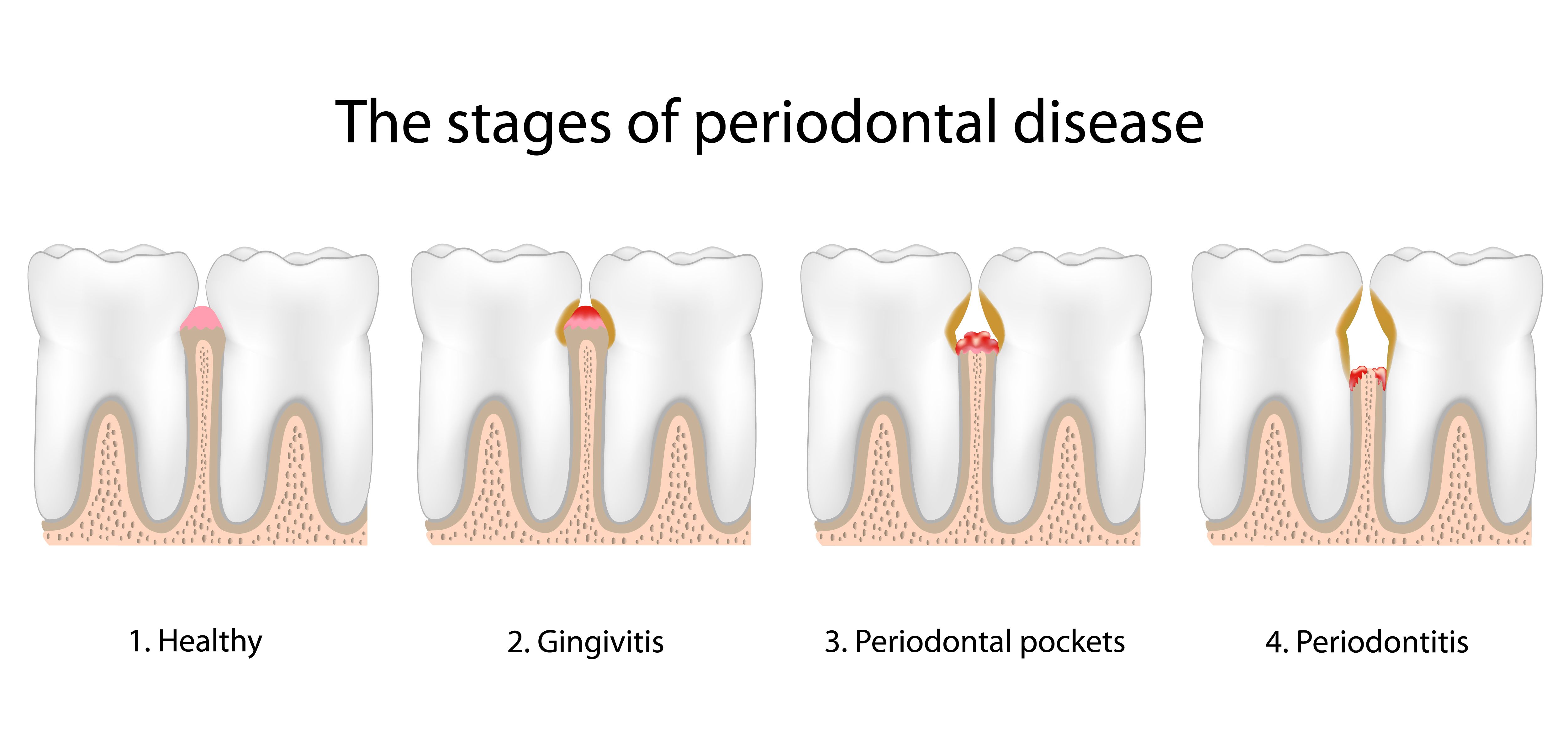 An illustration demonstrating the stages of periodontal disease