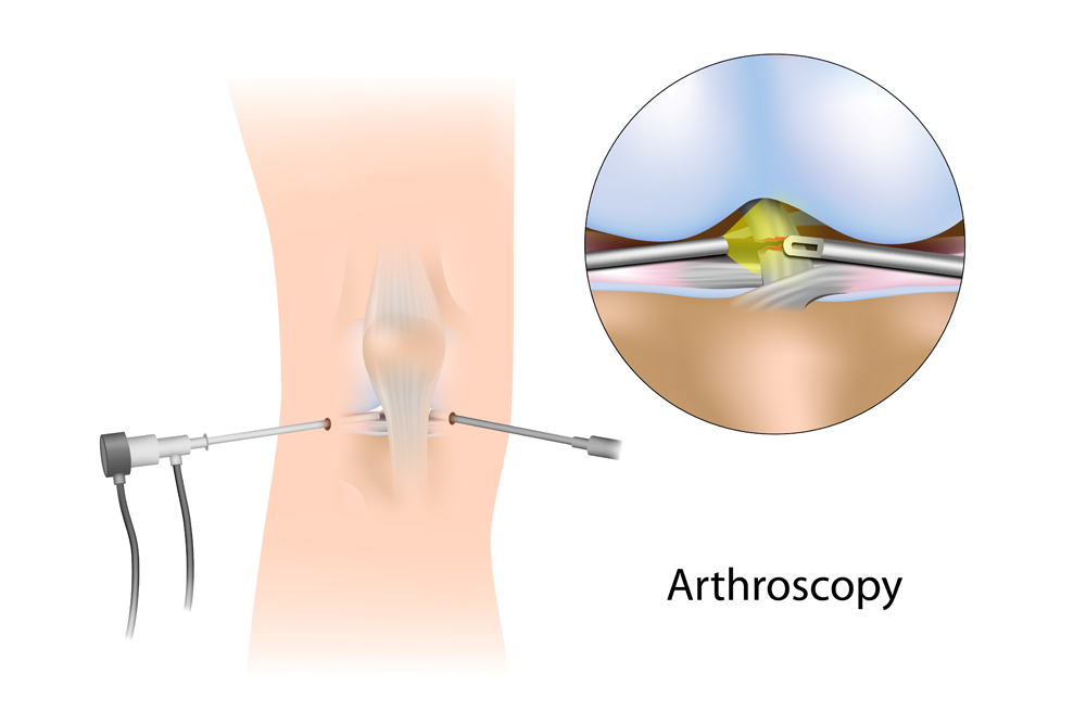 Arthroscopic knee reconstruction graphic