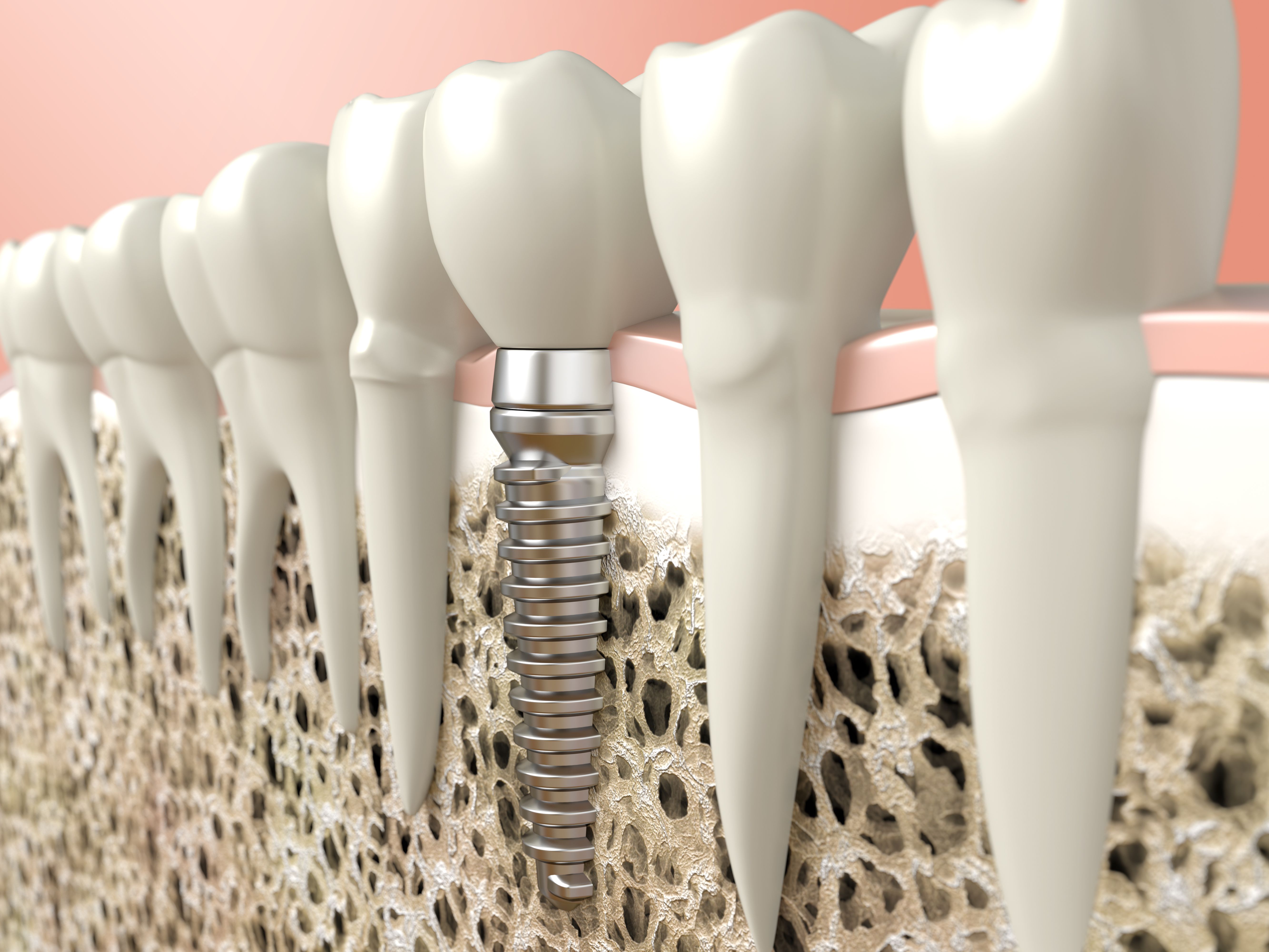 Placement of dental implants