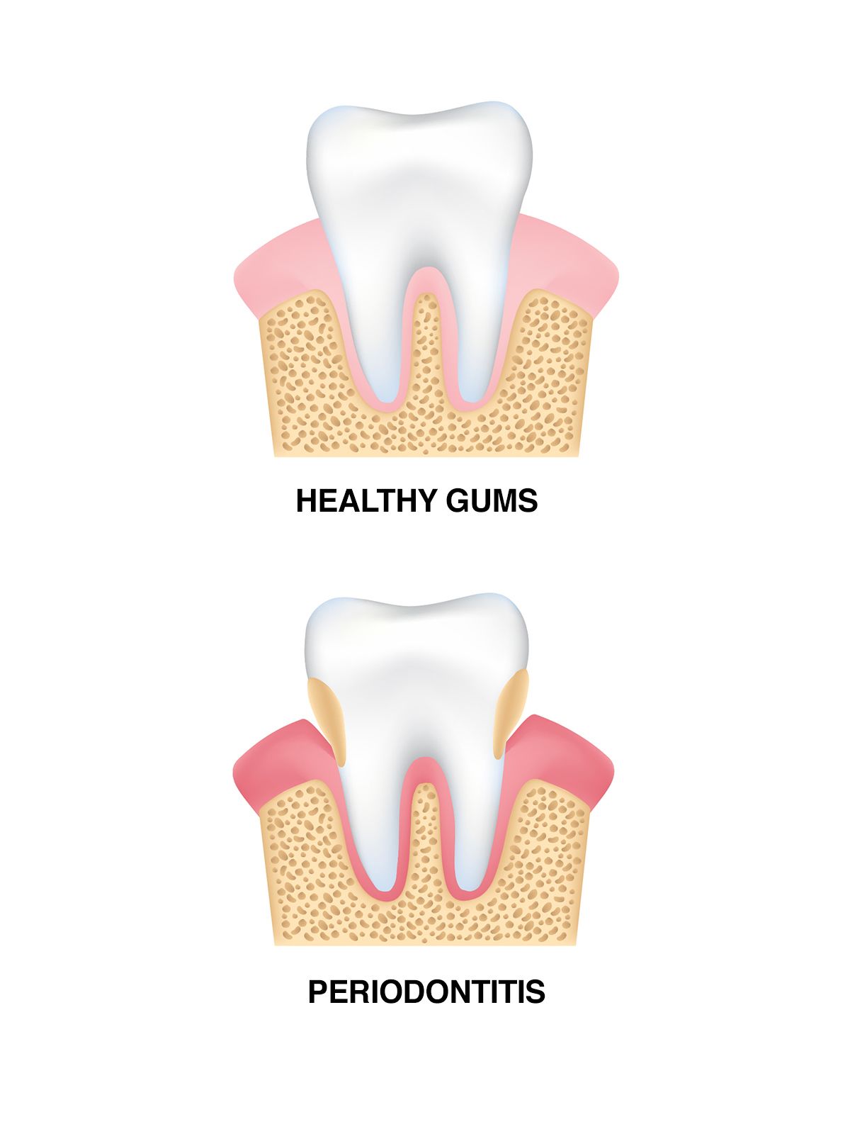 Periodontal Disease - Stages of Periodontal Disease - Before and After