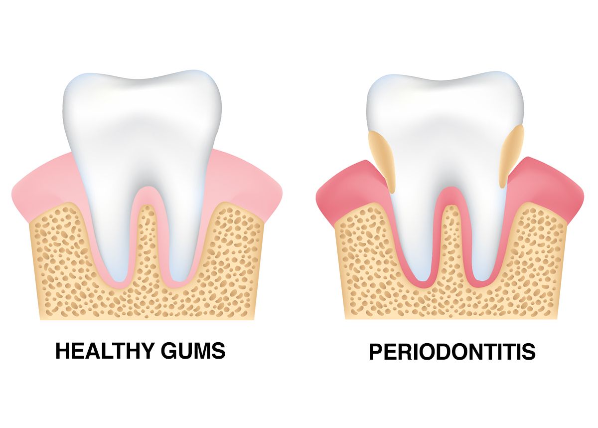 Illustration of healthy gums vs. periodontitis