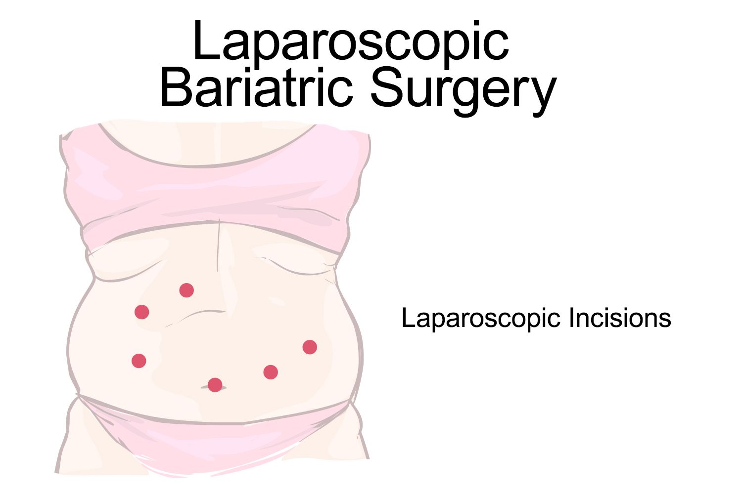 gastric sleeve incisions