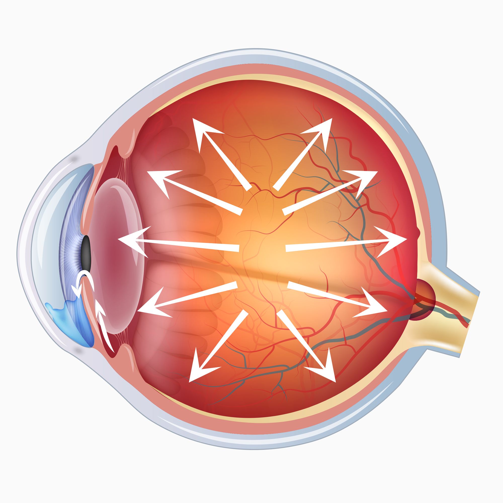 congenital glaucoma diagram