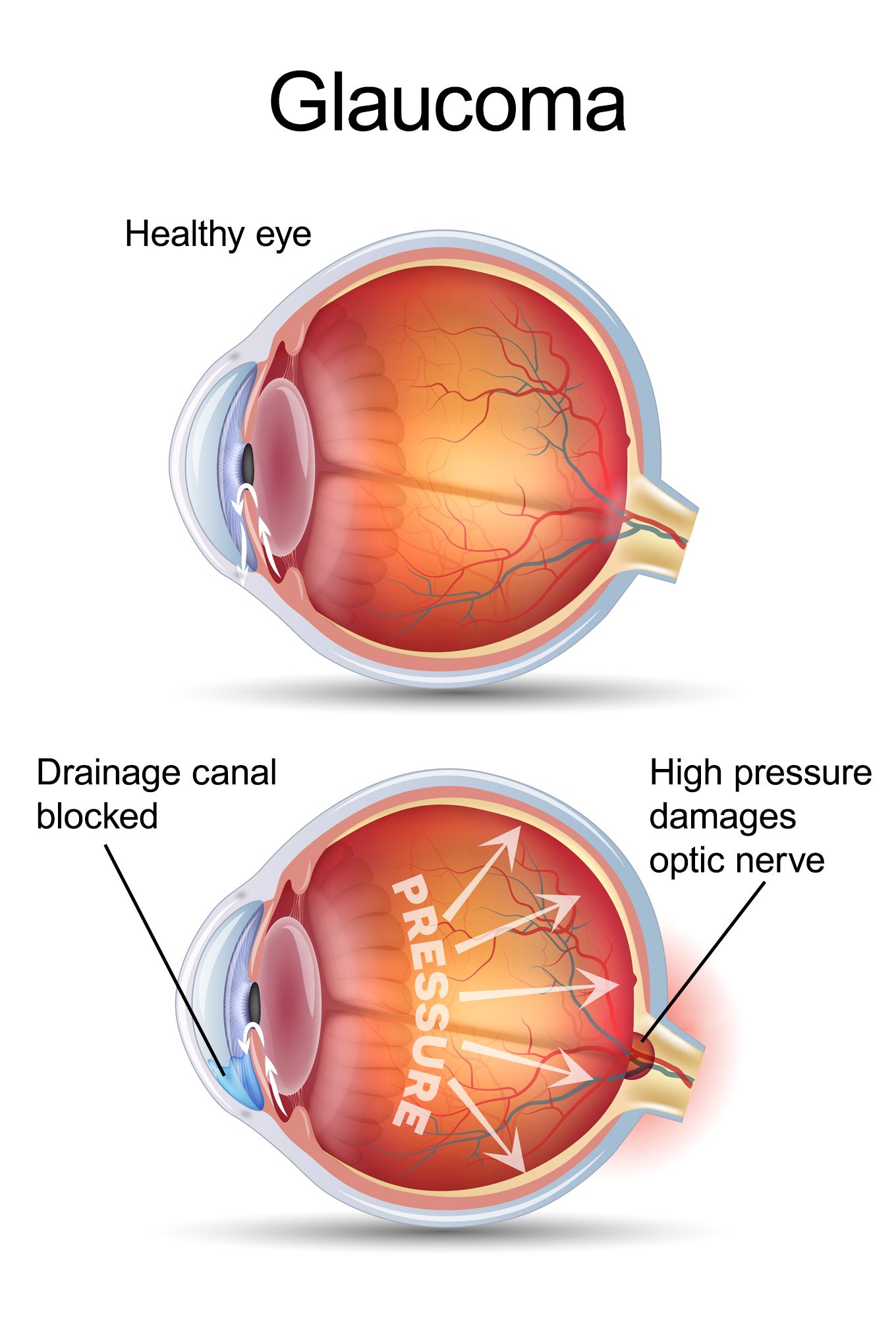 glaucoma laser surgery