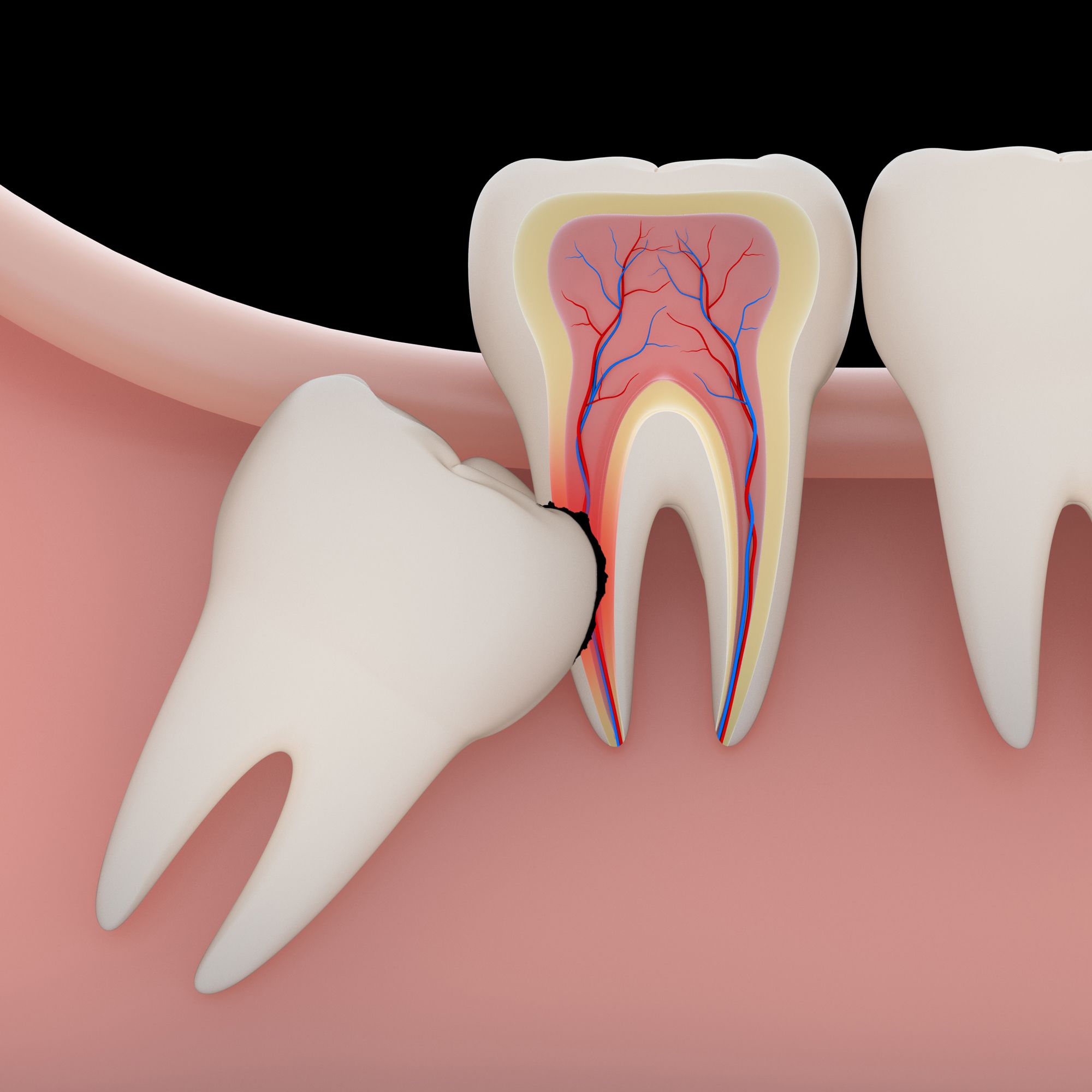 Albums 91+ Images pictures of impacted wisdom teeth Superb