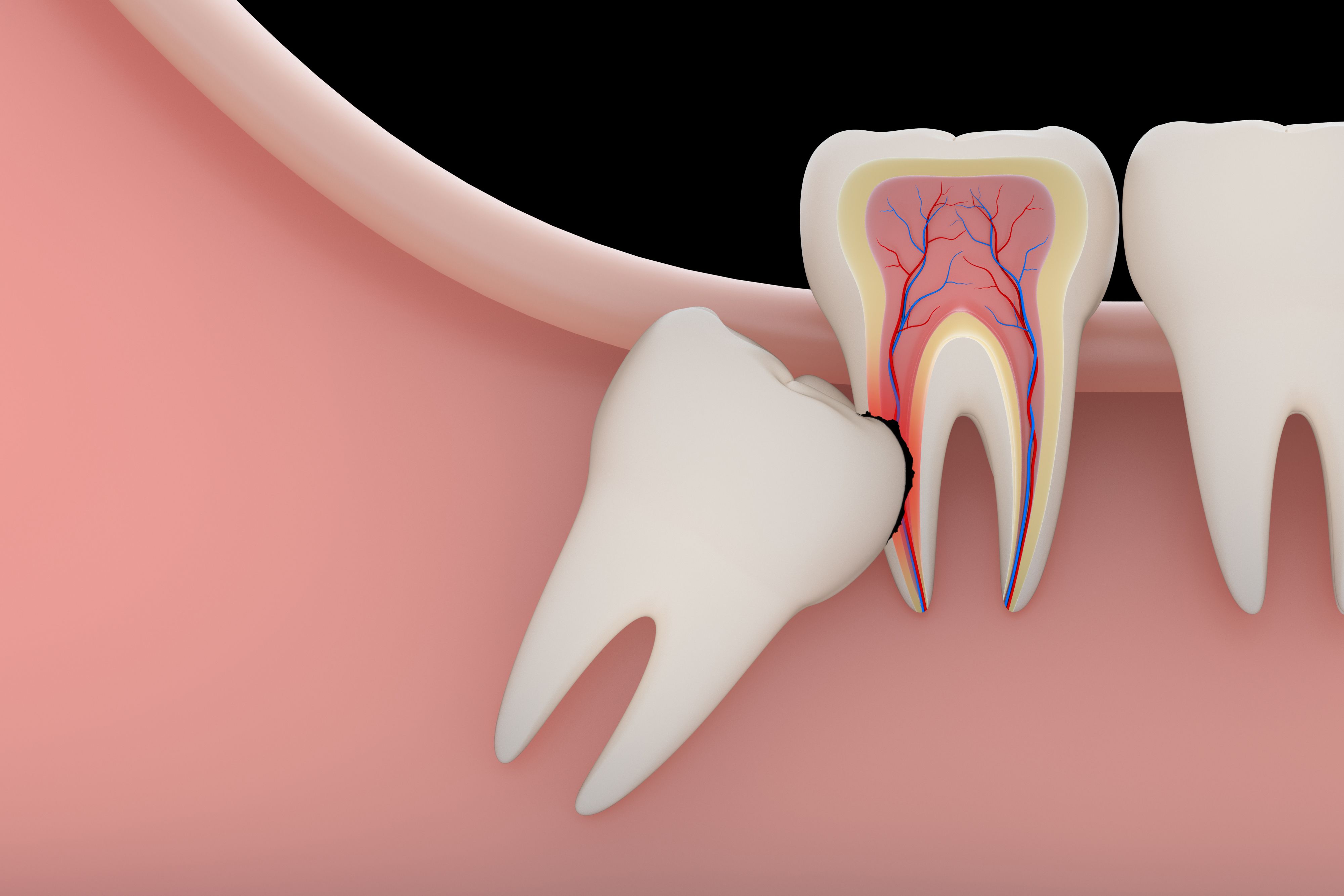 Illustration of a wisdom tooth growing into another tooth