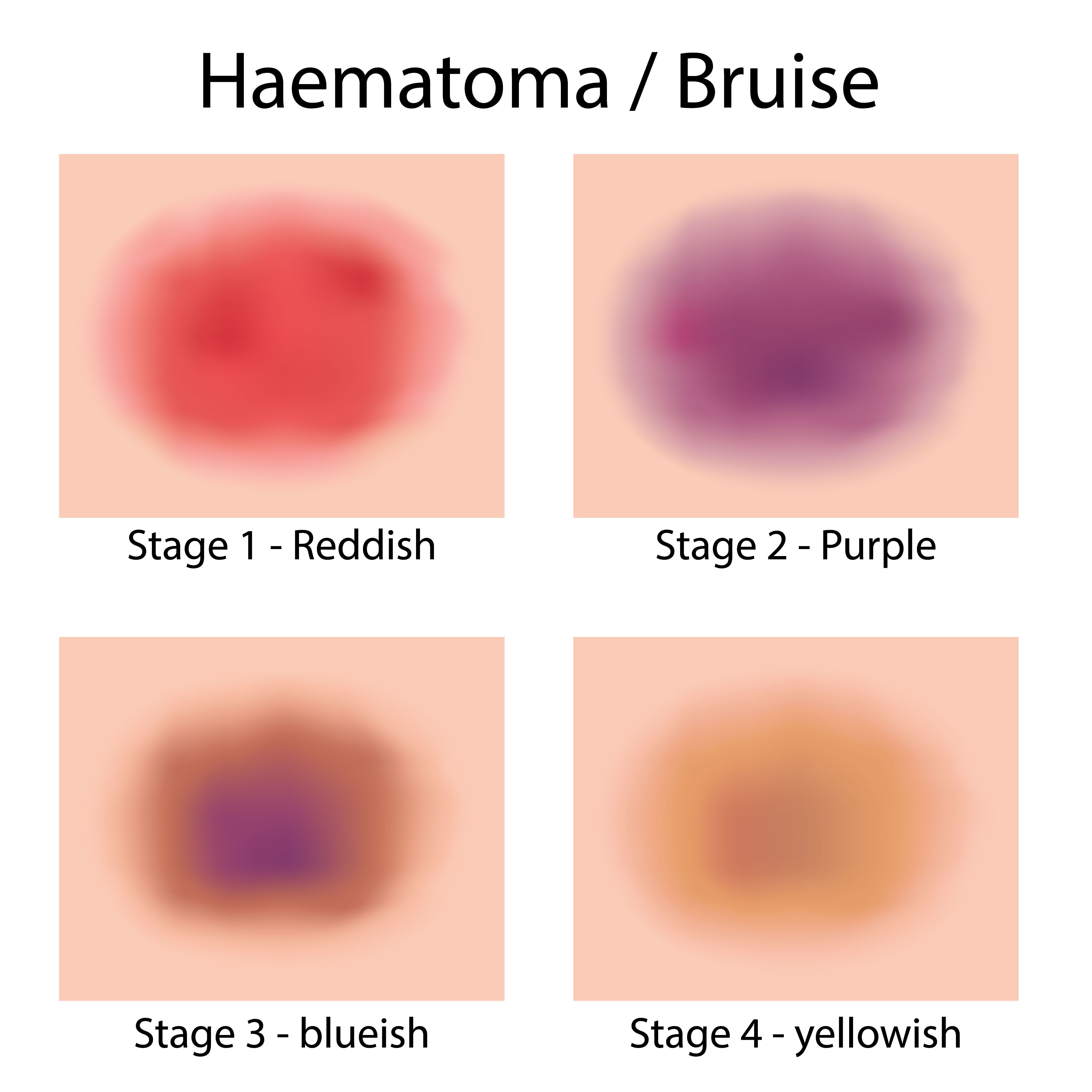 How Long Does Bruising Last After Sculptra At Lori Santiago Blog How Long Does Bruising Last After Sculptra At Lori Santiago Blog