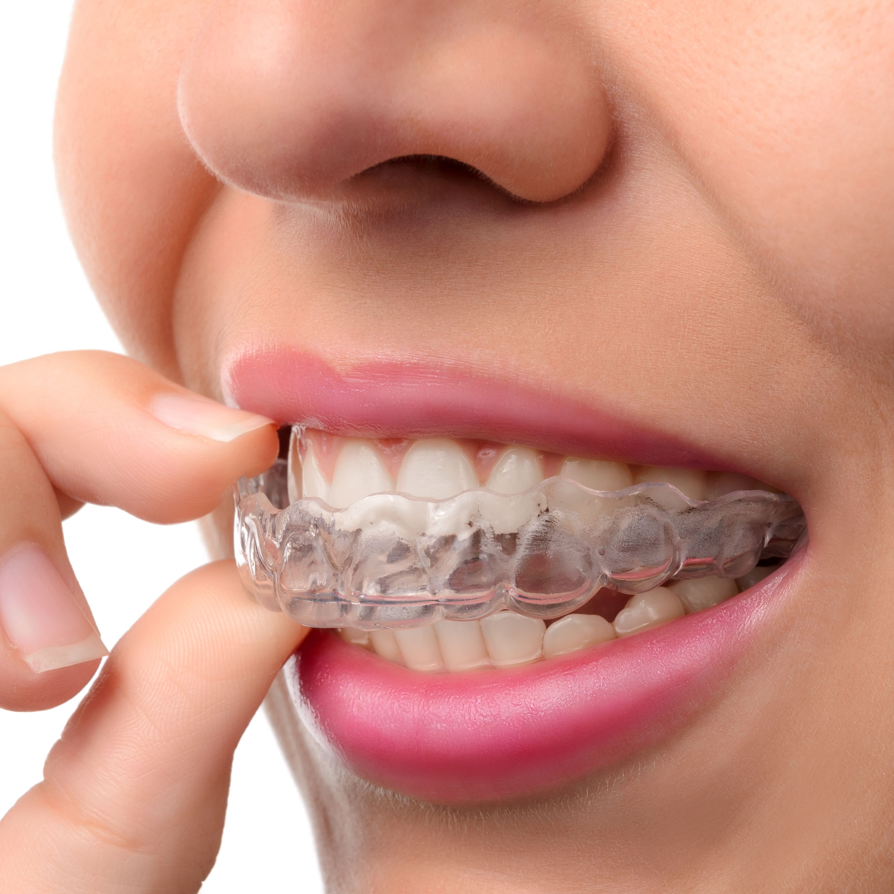 What Are Invisalign Rubber Bands?