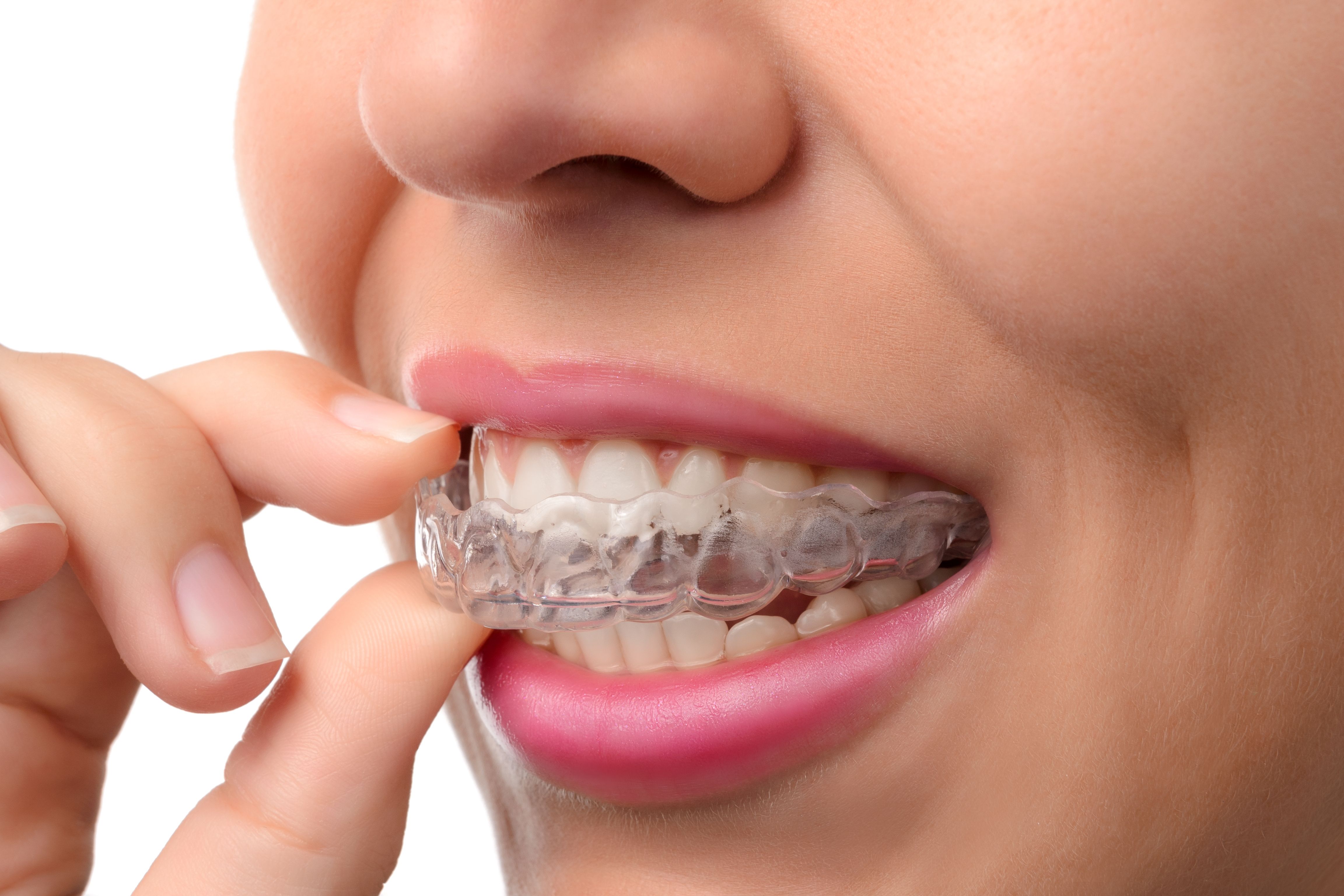  close up of woman placing Invisalign clear aligners over her teeth