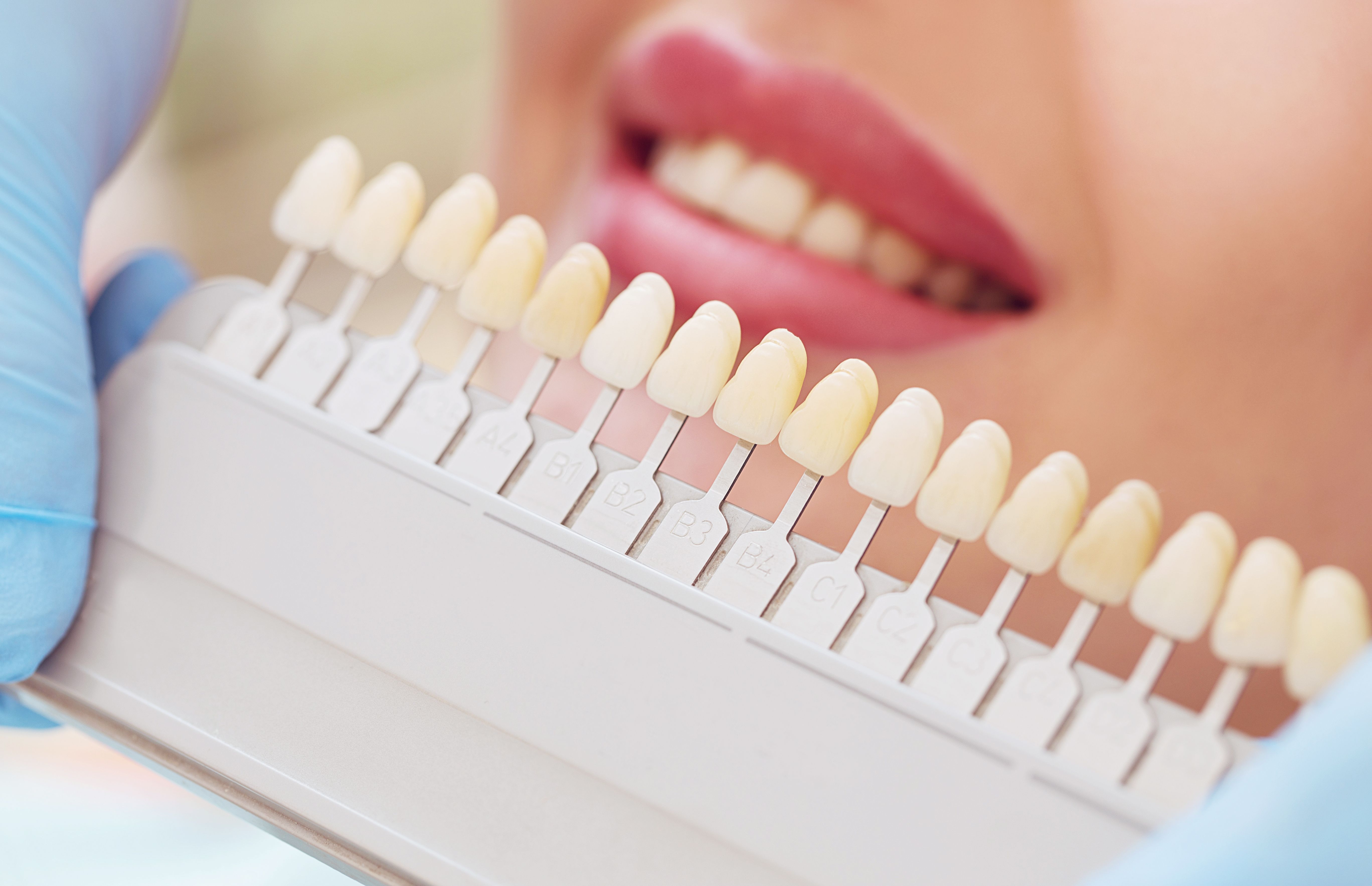 Teeth Whitening - Aria Dental - Family Dentist in San Antonio Texas