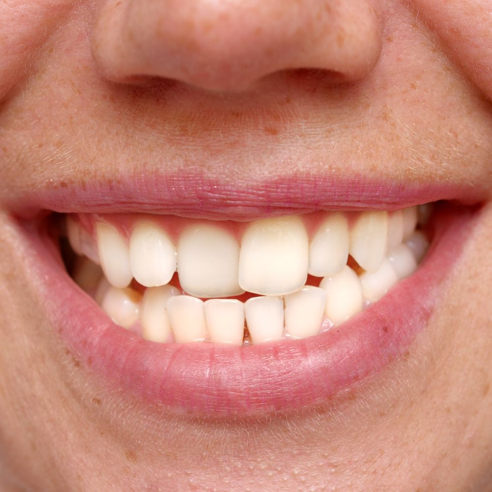 Can You Wear Braces on Your Top Teeth Only?