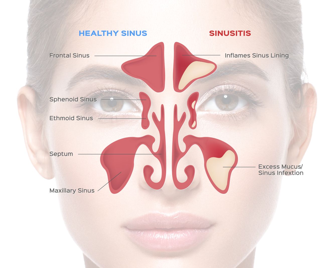 fungus in sinus cavity symptoms