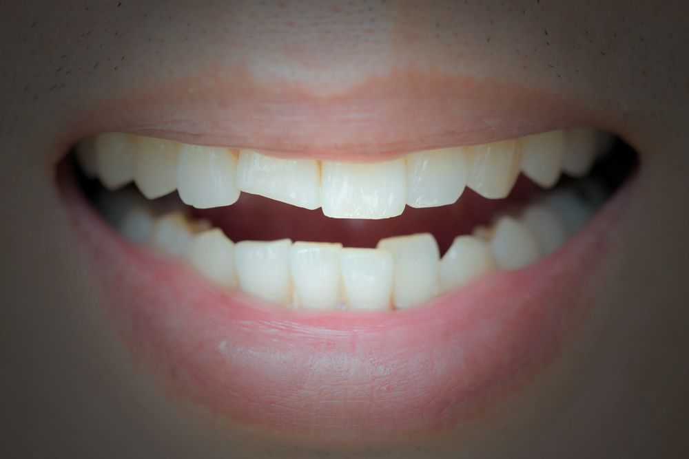 Dental Bonding vs. Veneers - Nashville, TN - Clint Newman, DDS