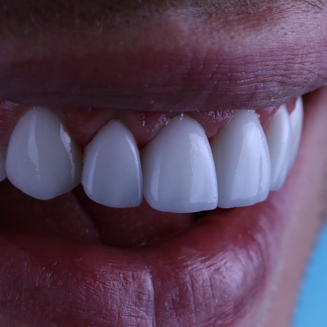 white teeth