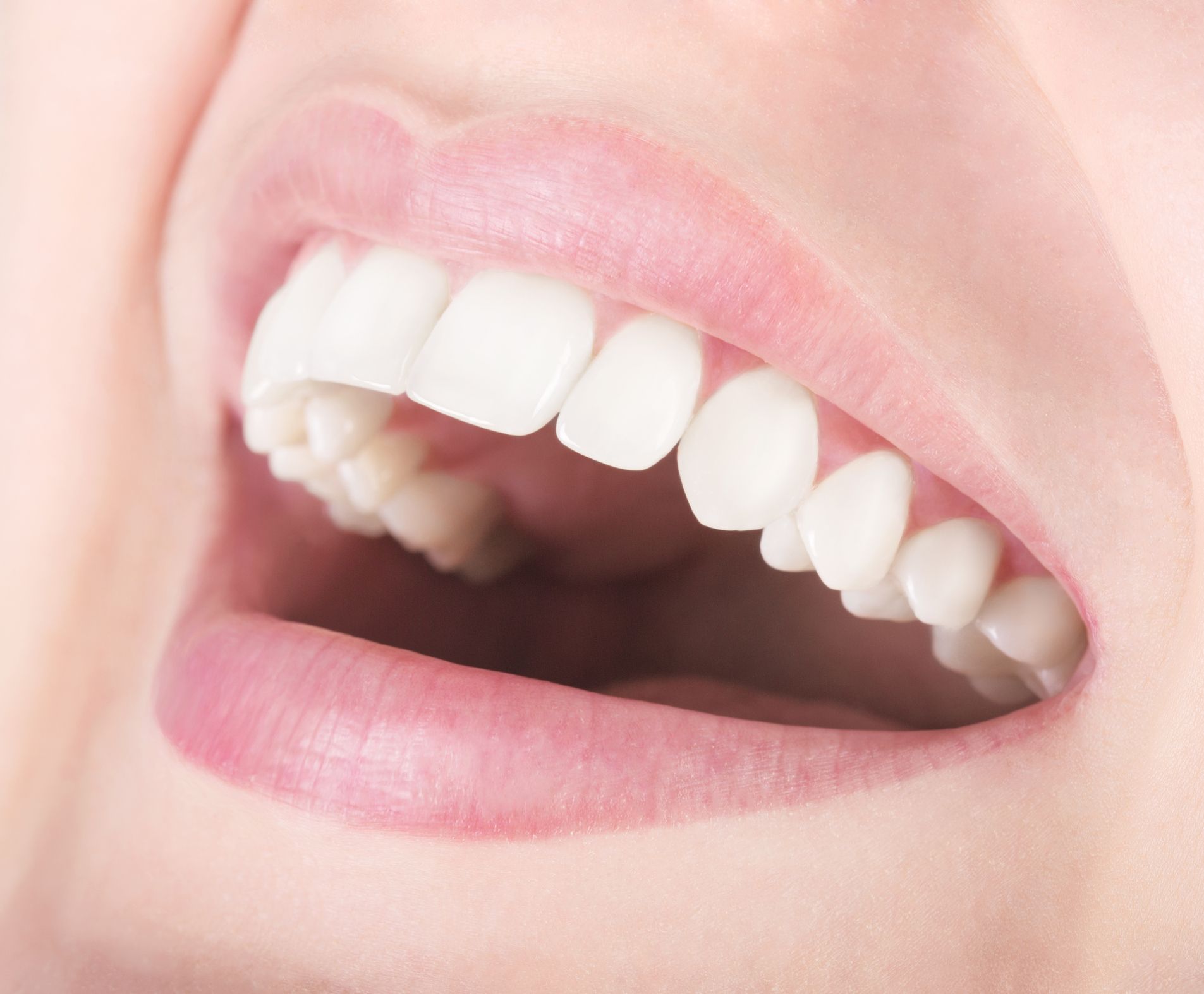 Dental Bonding vs Porcelain Veneers - Marietta, GA Cosmetic Dentistry