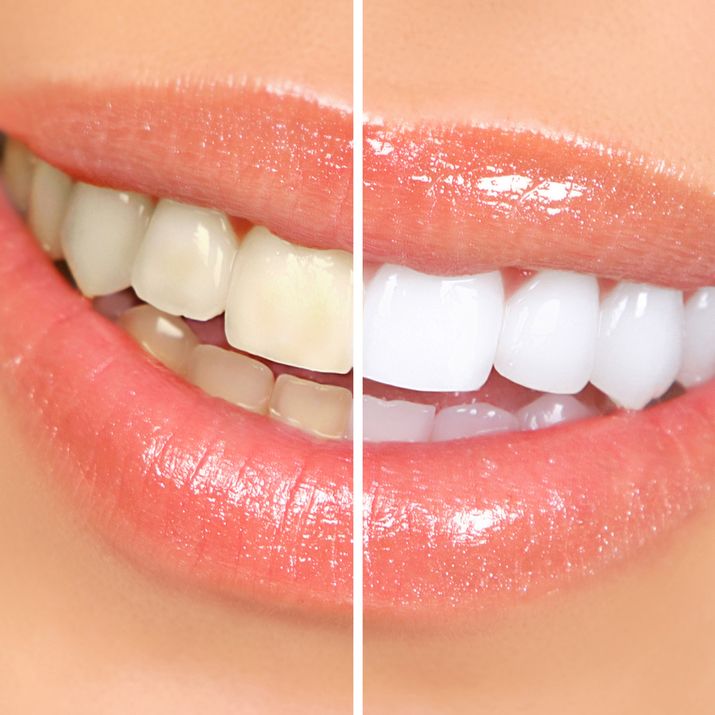 Before and after image of teeth whitening