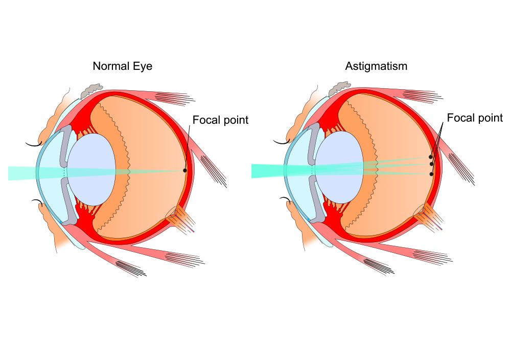 astigmatism-leesburg-fl-fishman-sheridan-eyecare-specialists