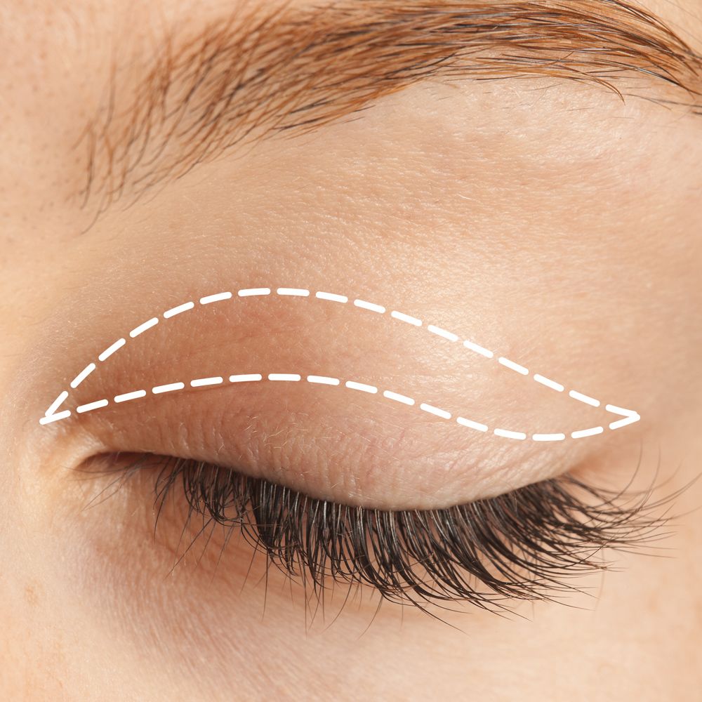 Incisions for upper eyelid surgery