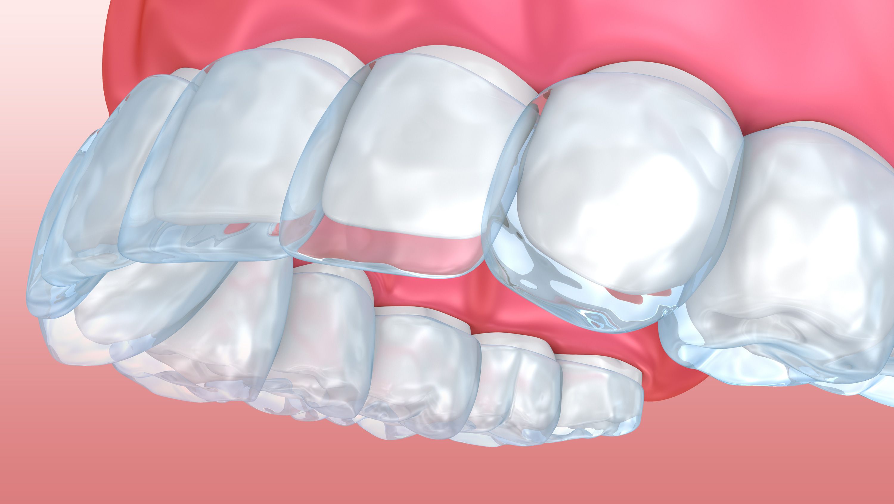 Adjusting to Your New Invisalign Trays 