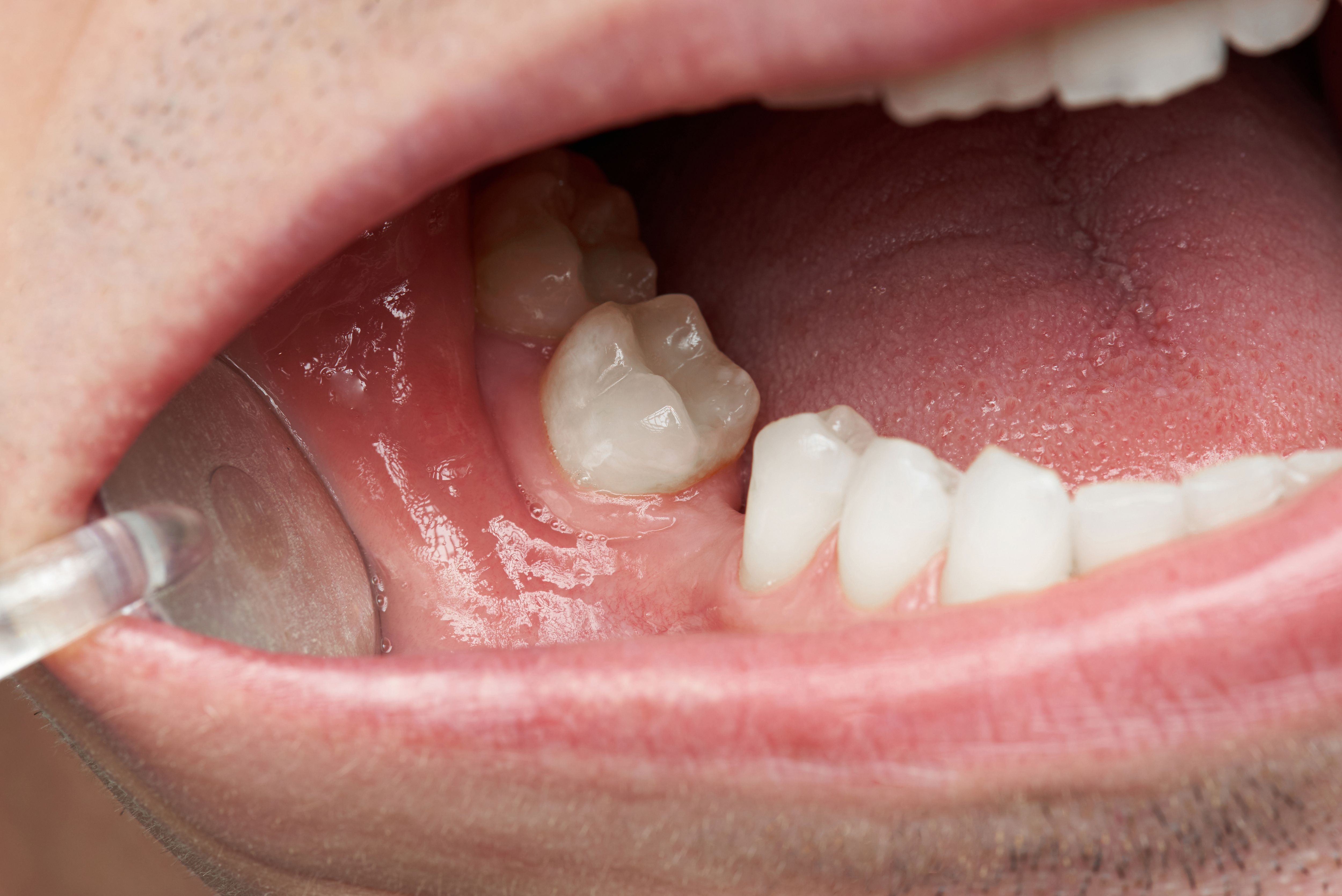 Can Infected Teeth Cause Heart Problems