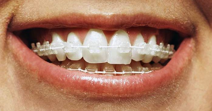 How to Keep Clear Braces From Turning Yellow