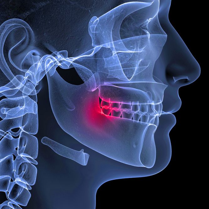3-D rendition of jaw with wisdom tooth in red