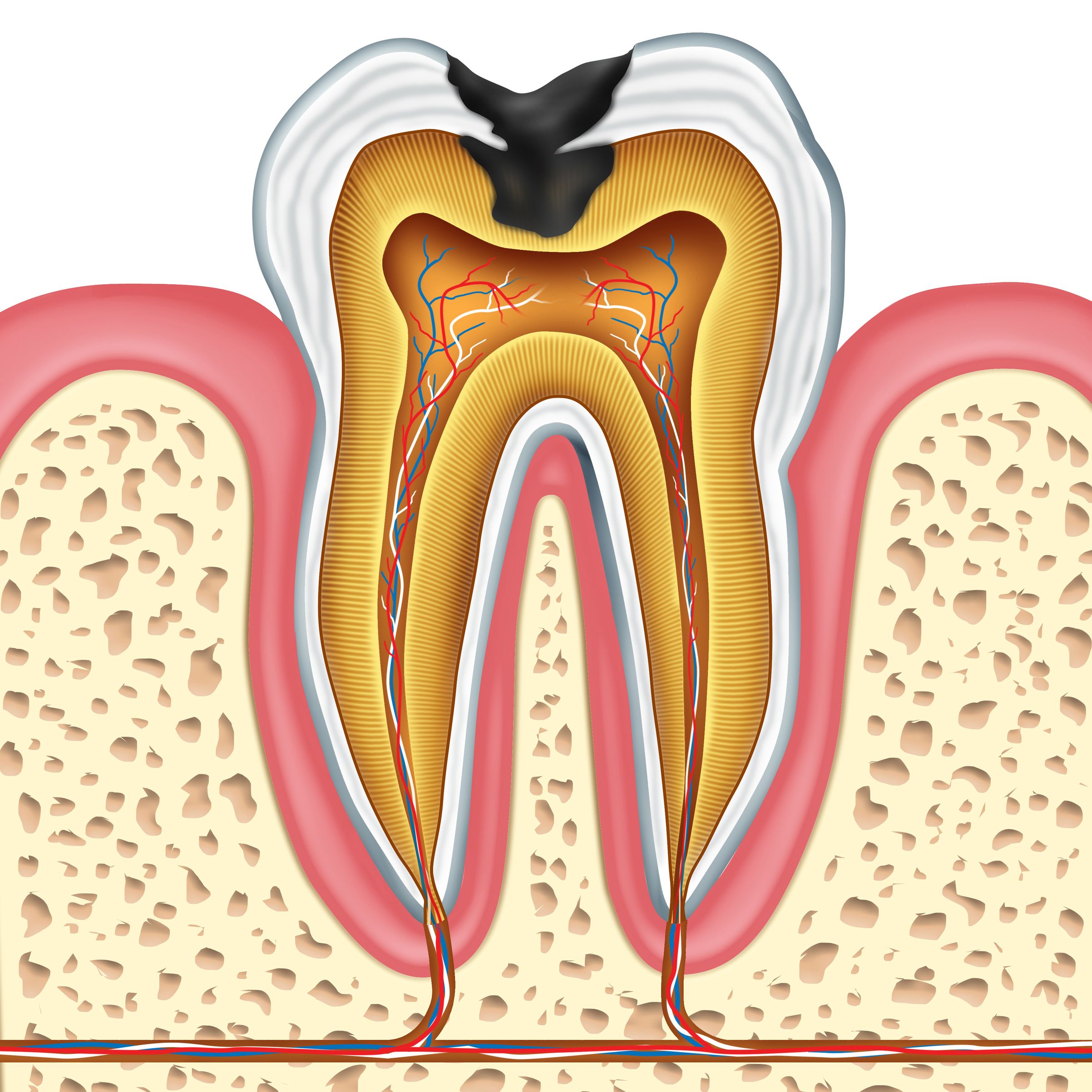 Root Canal Tooth Decay