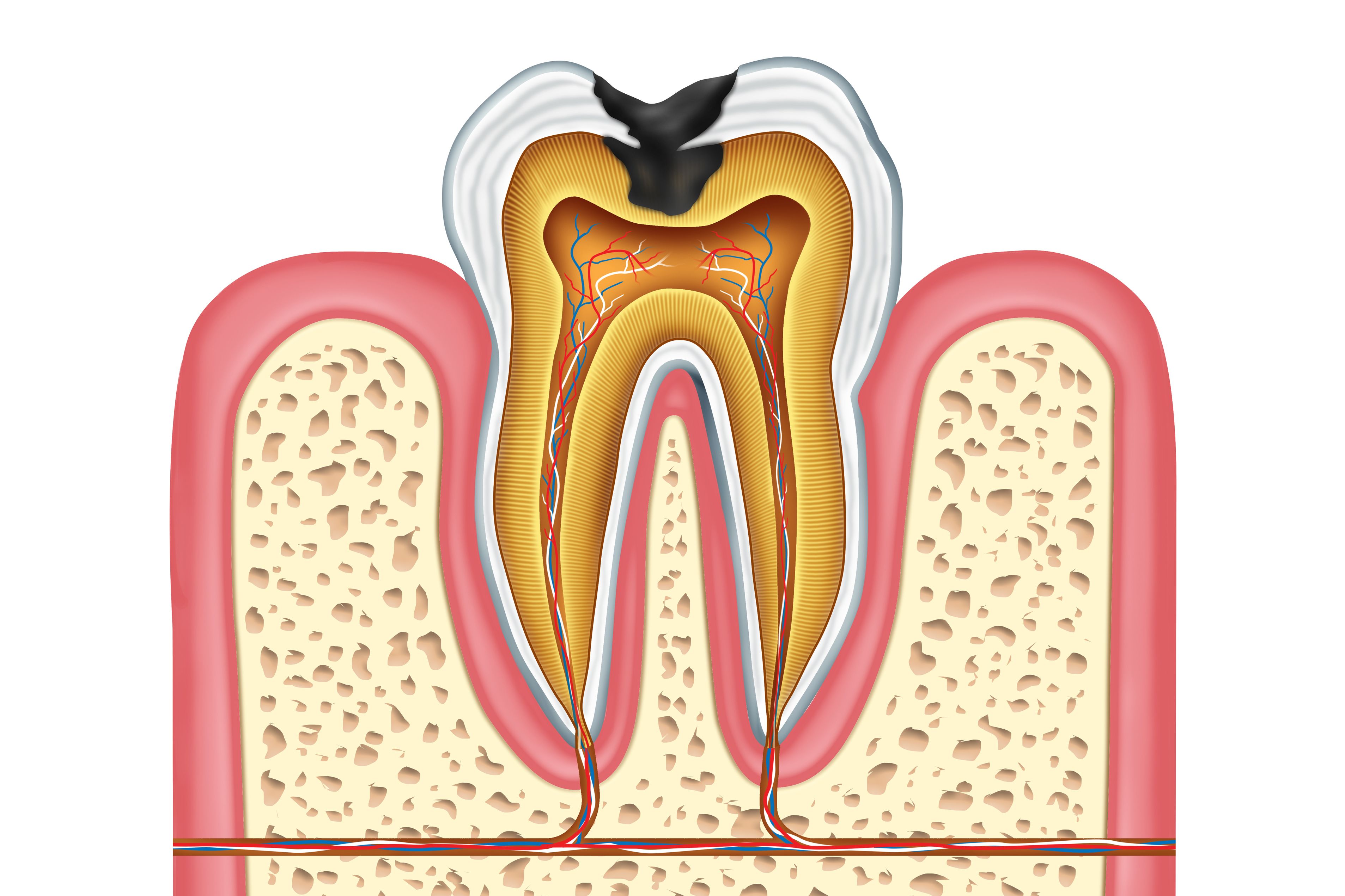 An illustration of a tooth with a cavity