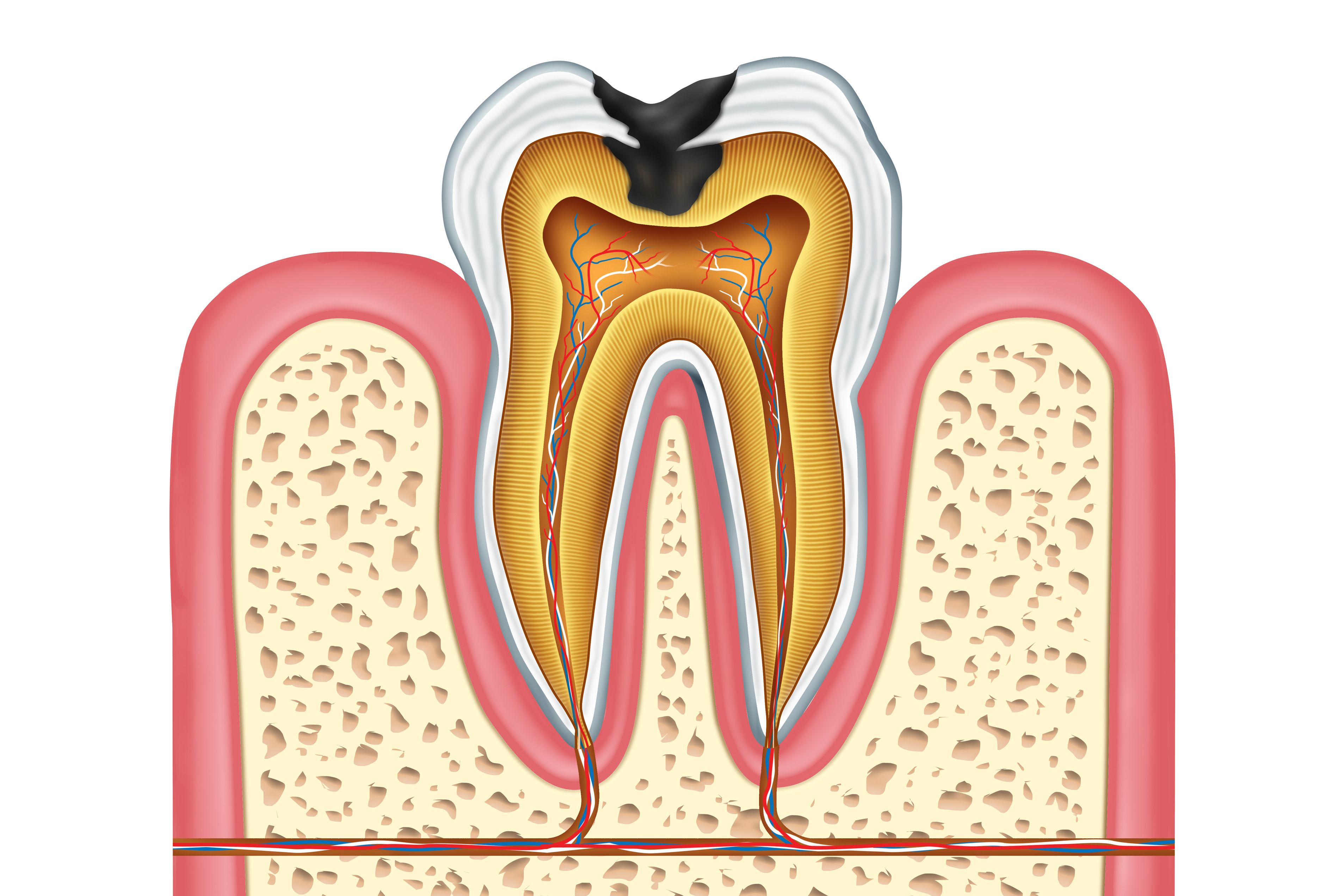 Cross-section of tooth with decay and root canal infection