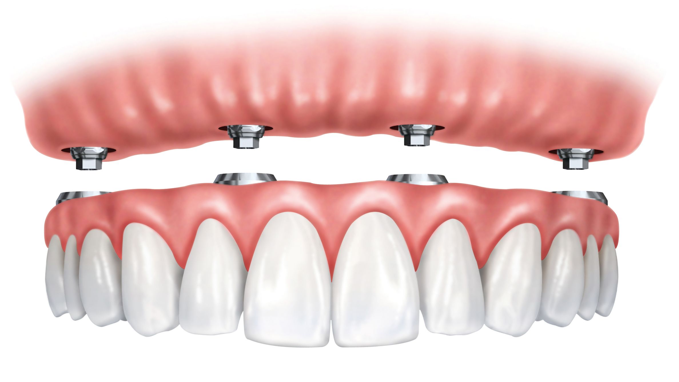 Dental Implants - Harrisonburg, VA - Smiles for Life