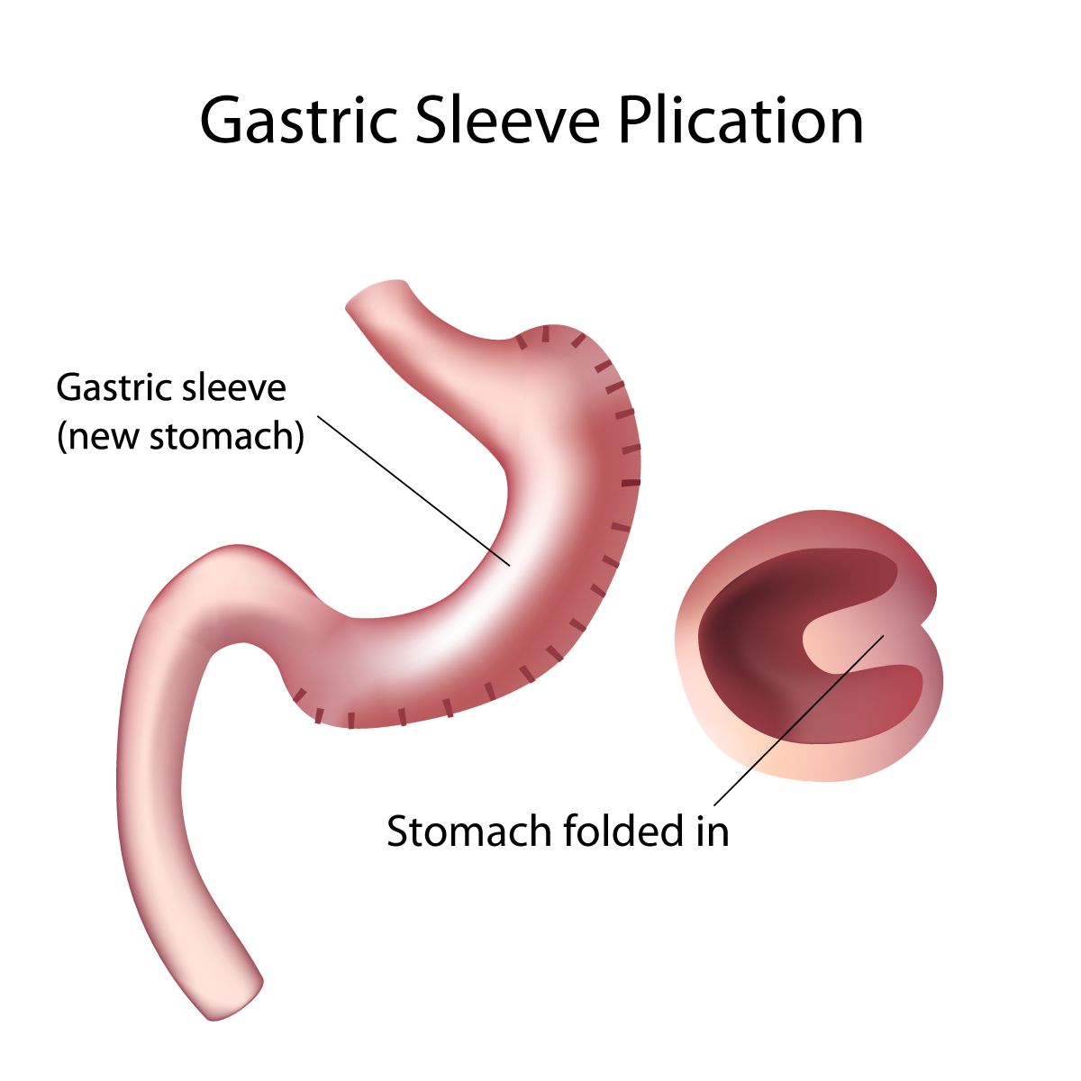 Gastric Bypass Surgery Revision - Tijuana, Mexico Resizing Stomach Pouch