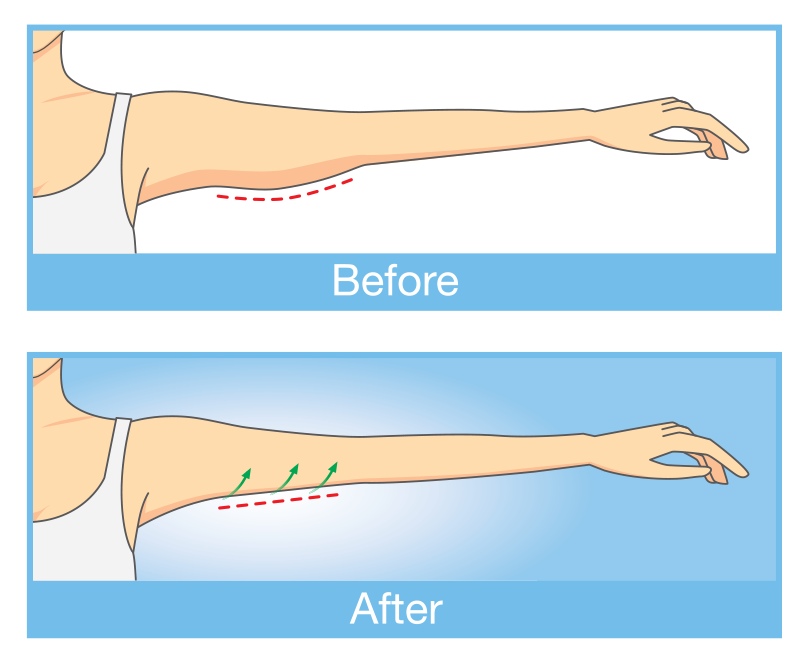 Arm Lift - Reducing the Appearance of Scars - Dallas, TX