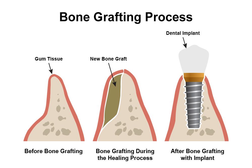 Implant Bone Grafting