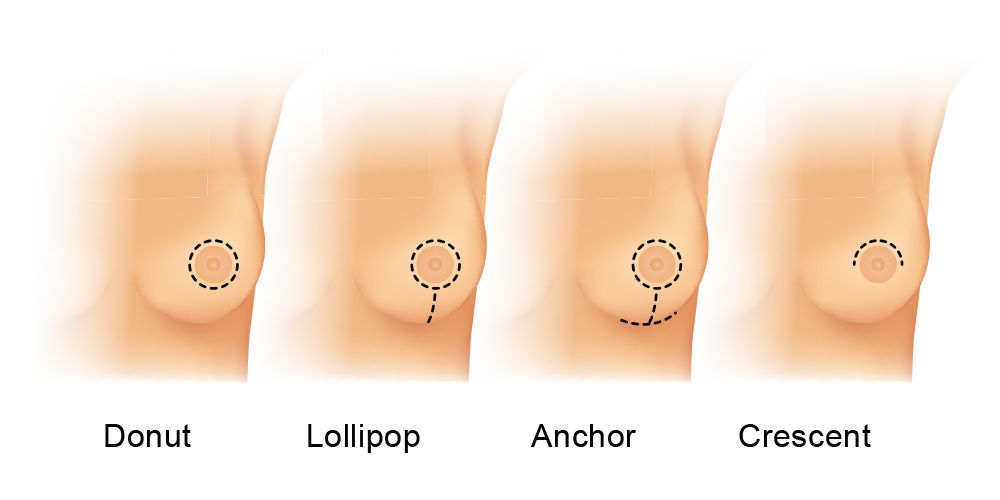 Dallas Areolar Breast Augmentation Incision: Surgery Techniques