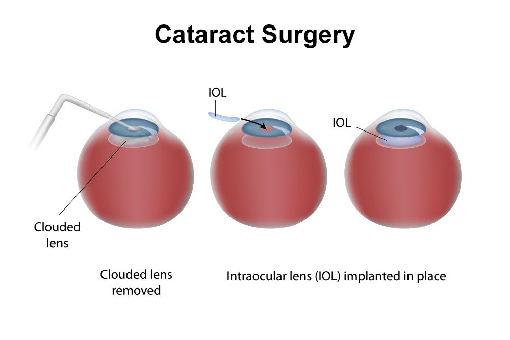 What Type Of Lens For Cataract Surgery Covered By Medicare?